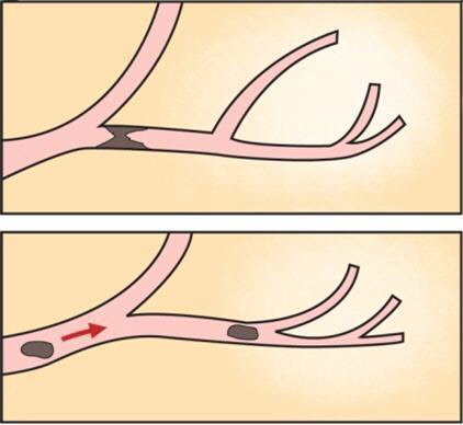 심부 정맥 혈전 <서울아산병원 제공>